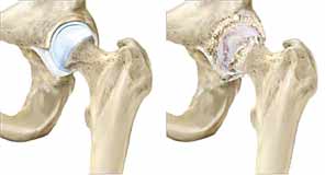 آرتروز مفصل لگن یا ران ( ساییدگی یا استئوآرتریت هیپ)
